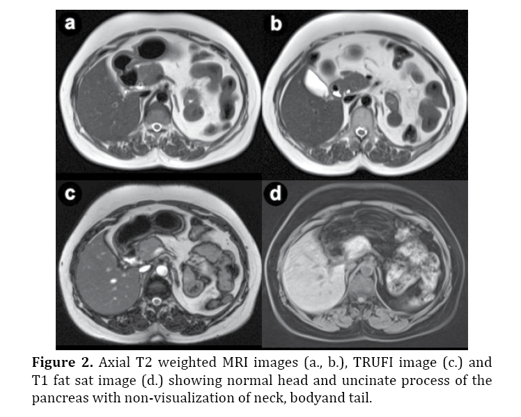 pancreas-head-uncinate-process