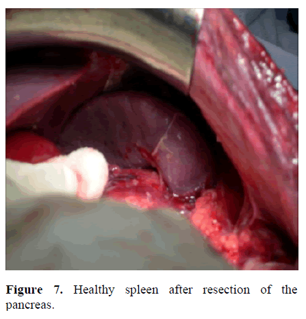 pancreas-healthy-spleen-pancreas