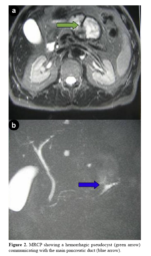 pancreas-hemorrhagic-pseudocyst