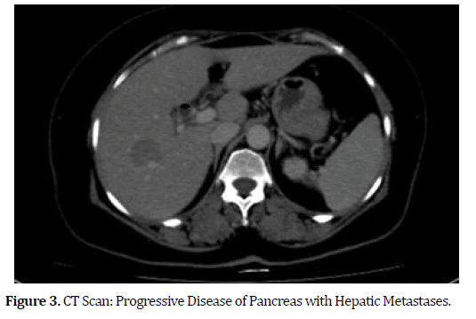 pancreas-hepatic-metastases