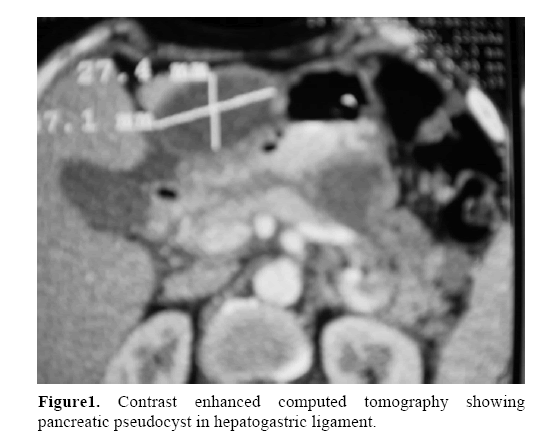 pancreas-hepatogastric-ligament