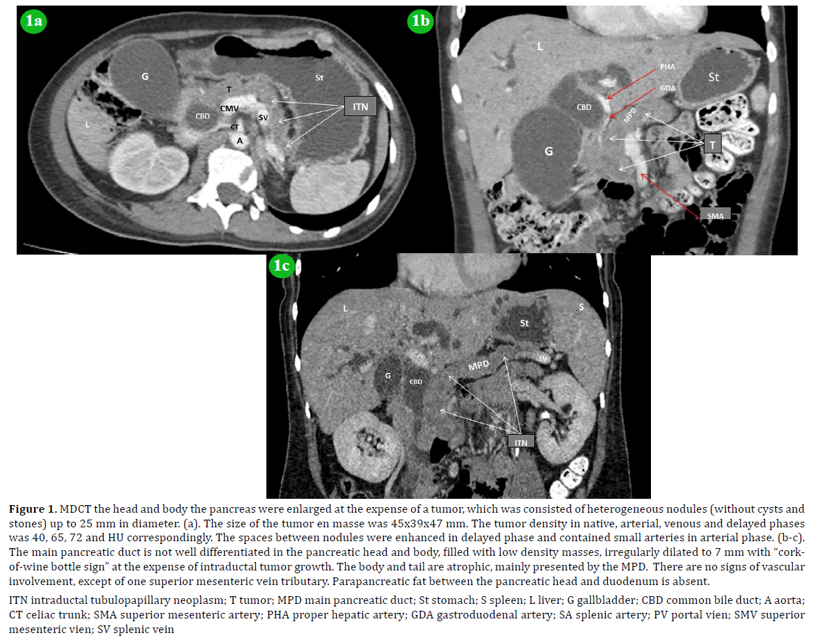 pancreas-heterogeneous-nodules