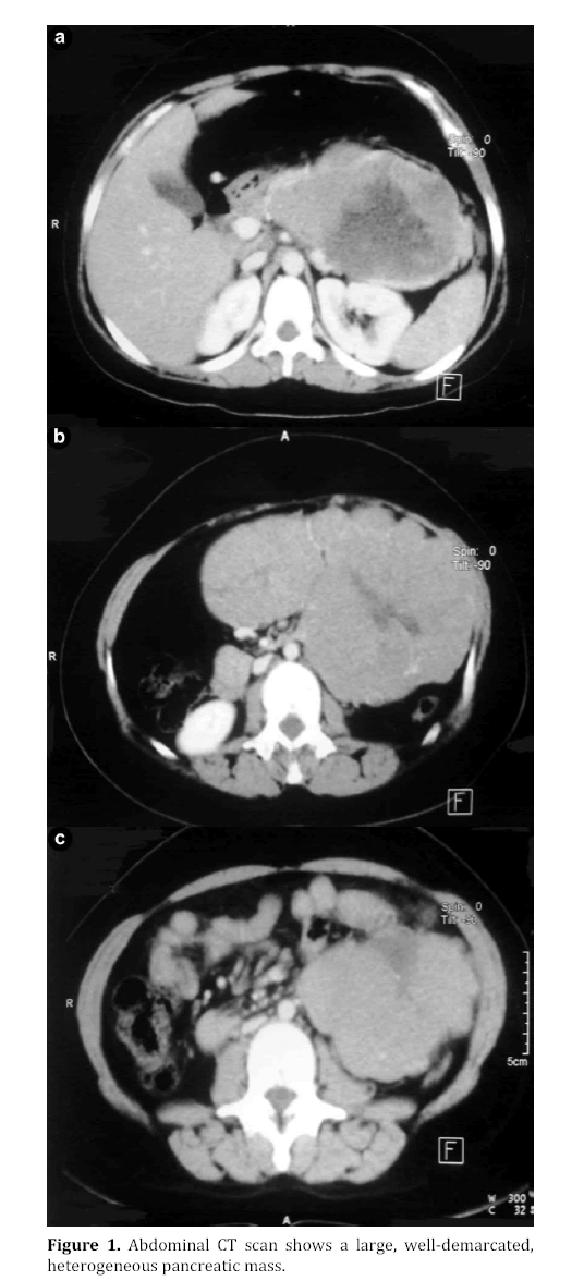 pancreas-heterogeneous-pancreatic-mass