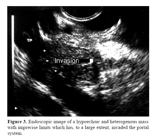 pancreas-heterogenous-mass