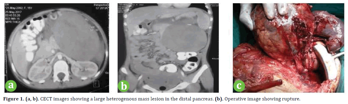 pancreas-heterogenous-mass-lesion
