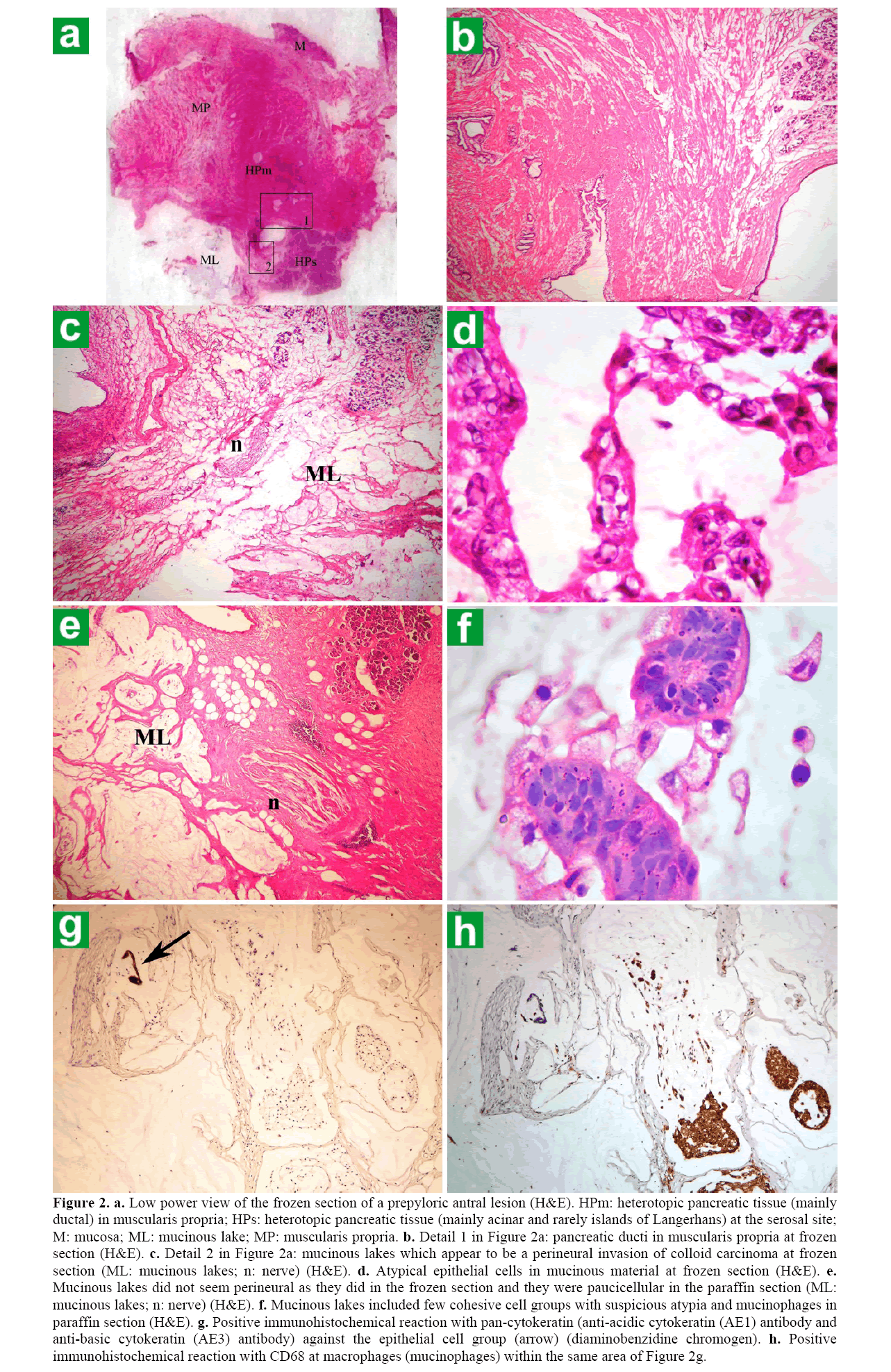 pancreas-heterotopic-pancreatic-tissue