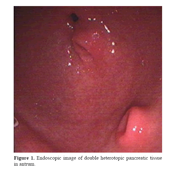 pancreas-heterotopic-pancreatic-tissue