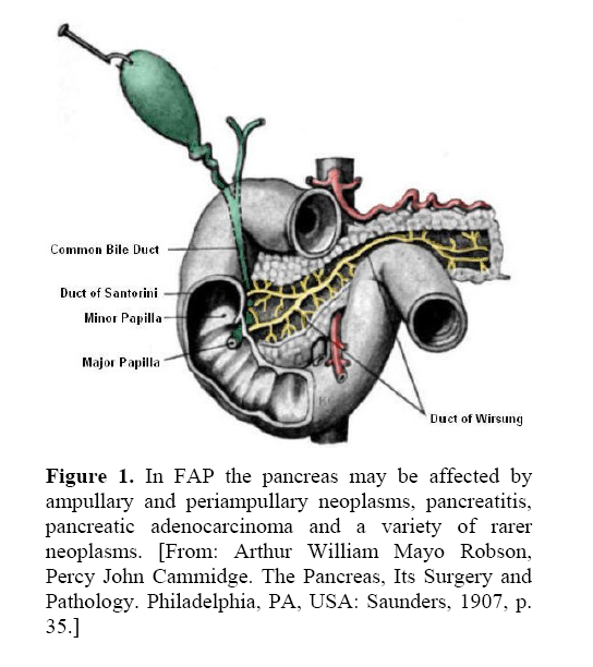 pancreas-high-grade-intraepithelial-neoplasia