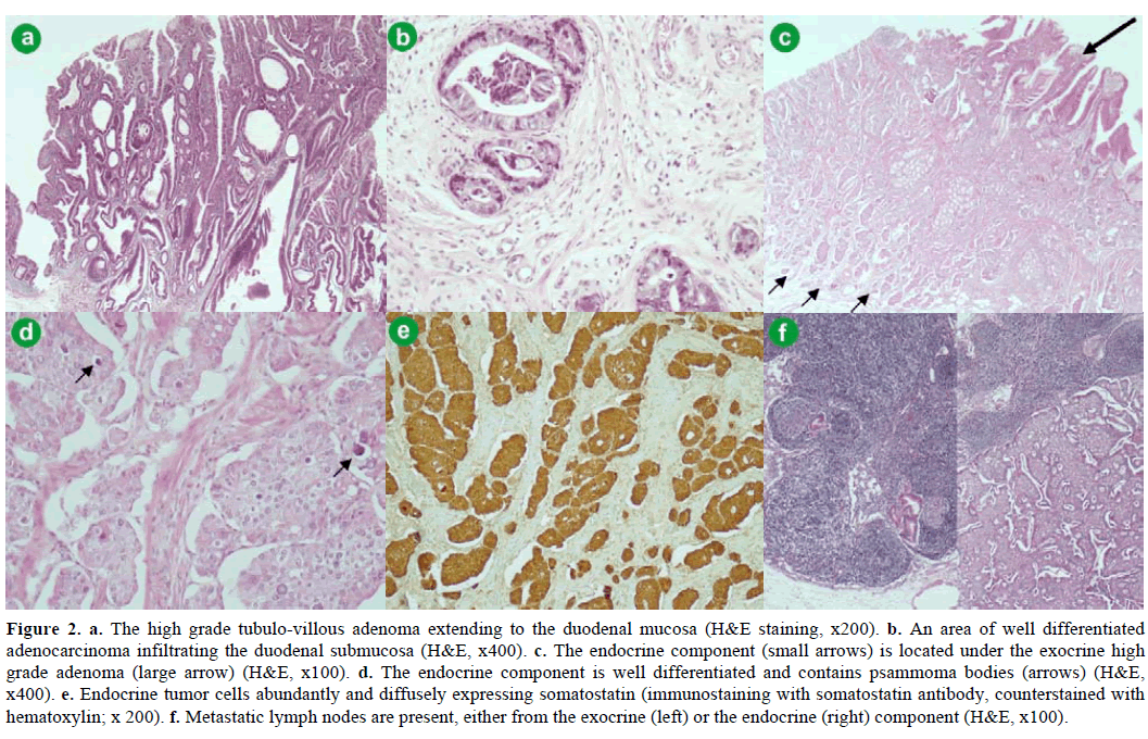 pancreas-high-grade-tubulo-villous