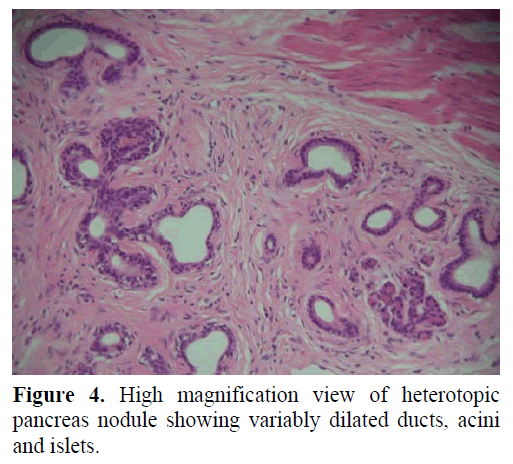 pancreas-high-magnification-heterotopic