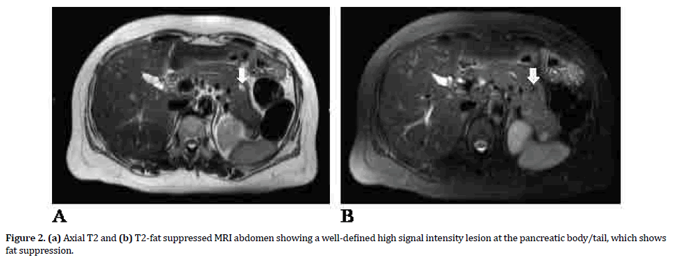 pancreas-high-signal-intensity