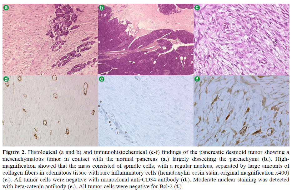 pancreas-histological-desmoid-tumor