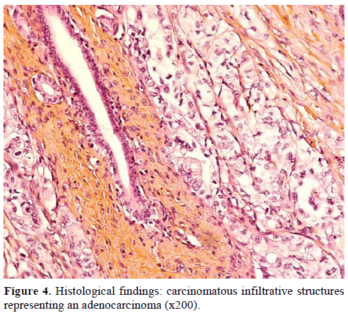 pancreas-histological-findings-carcinomatous