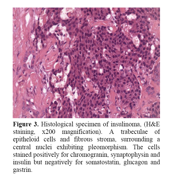 pancreas-histological-specimen-insulinoma