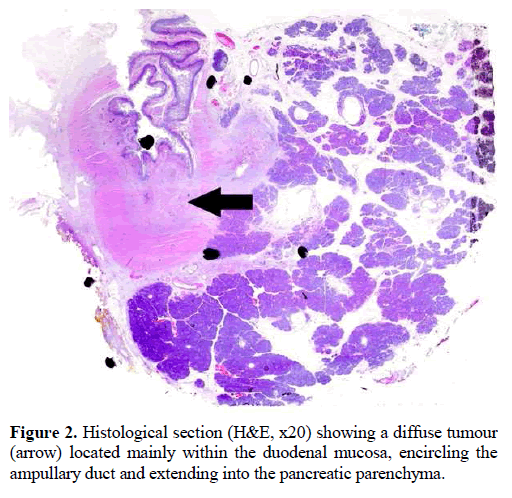 pancreas-histological-tumour-duodenal