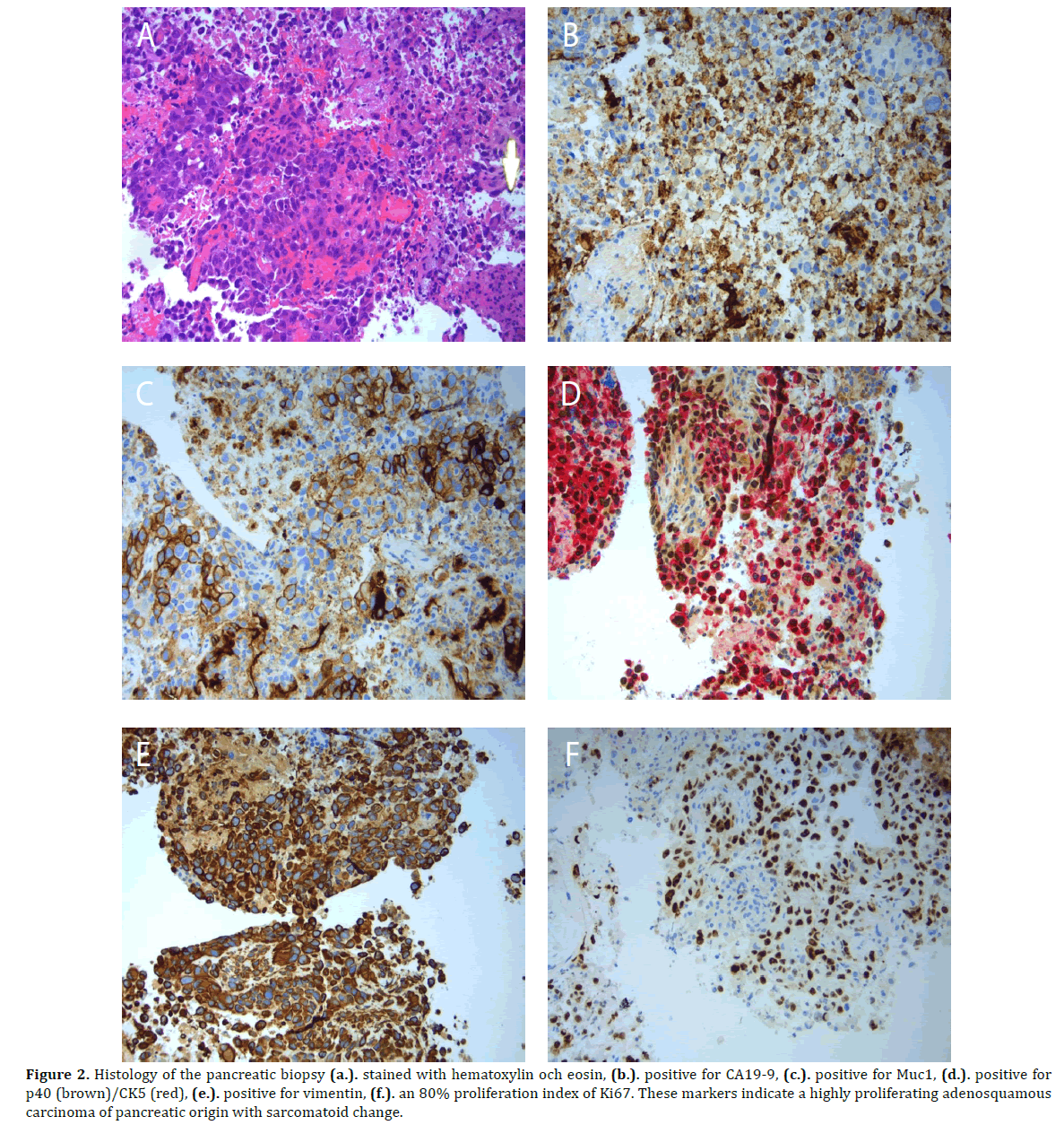 pancreas-histology-pancreatic-biopsy