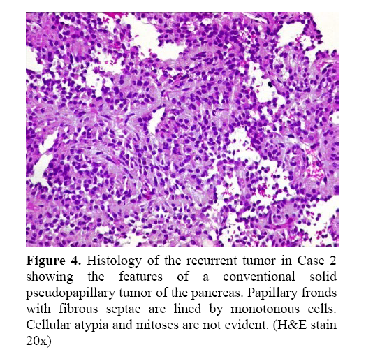 pancreas-histology-recurrent-tumor