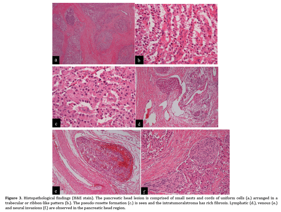 pancreas-histopathological-findings