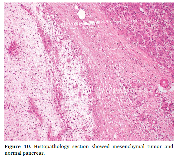pancreas-histopathology-mesenchymal-tumor
