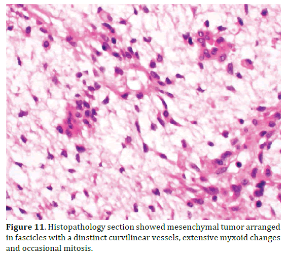 pancreas-histopathology-mesenchymal-tumor