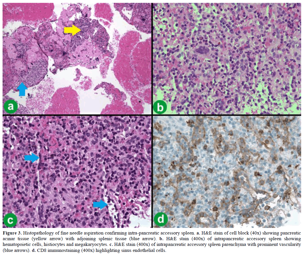 pancreas-histopathology-needle-aspiration