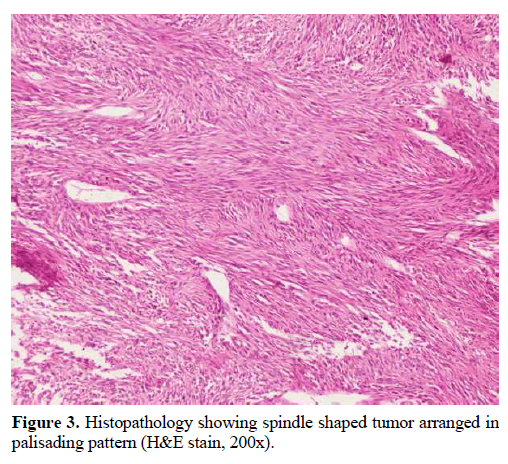 pancreas-histopathology-spindle-shaped-tumor