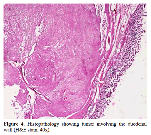 pancreas-histopathology-tumor-duodenal-wall