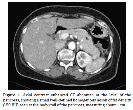 pancreas-homogenous-lesion