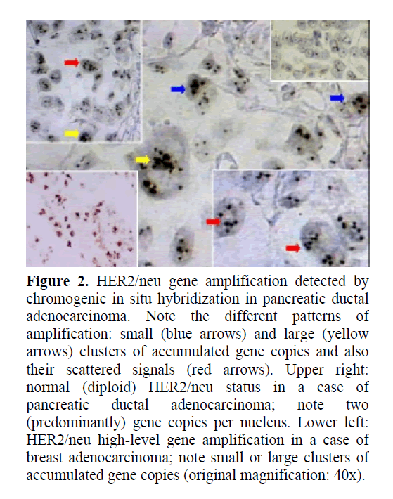 pancreas-hybridization-pancreatic-ductal