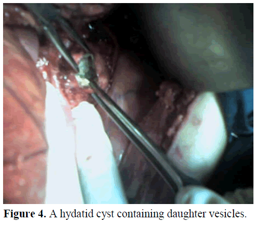 pancreas-hydatid-cyst-daughter-vesicles