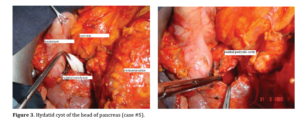 pancreas-hydatid-cyst-head