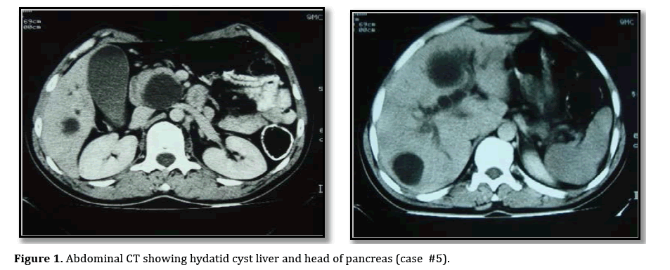 pancreas-hydatid-cyst-liver