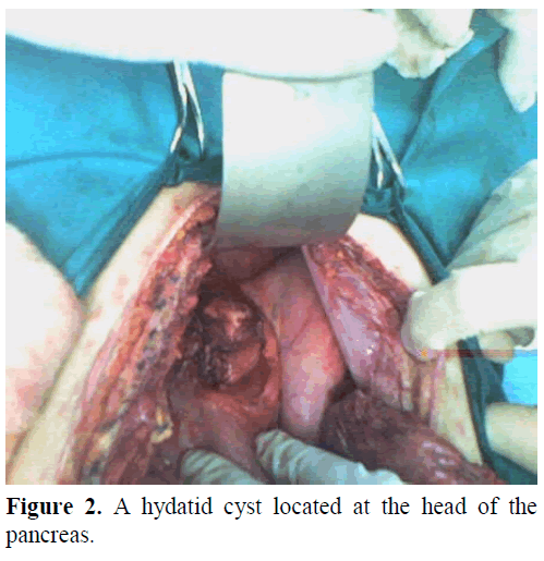 pancreas-hydatid-cyst-pancreas