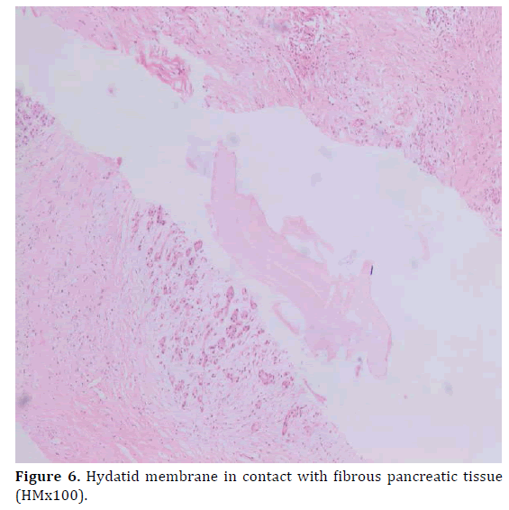 pancreas-hydatid-membrane-contact