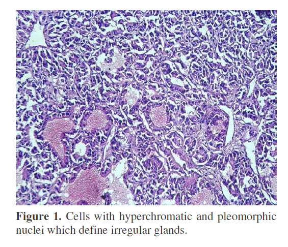 pancreas-hyperchromatic-and-pleomorphic