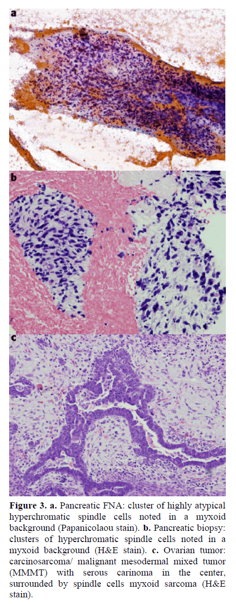 pancreas-hyperchromatic-spindle-cells