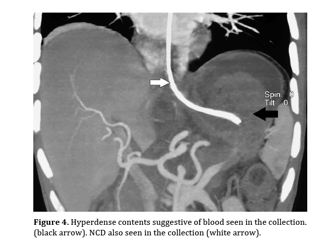 pancreas-hyperdense-contents-suggestive