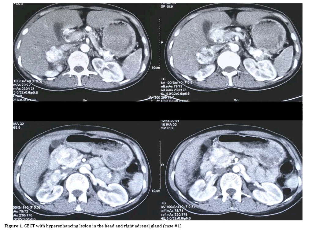 pancreas-hyperenhancing