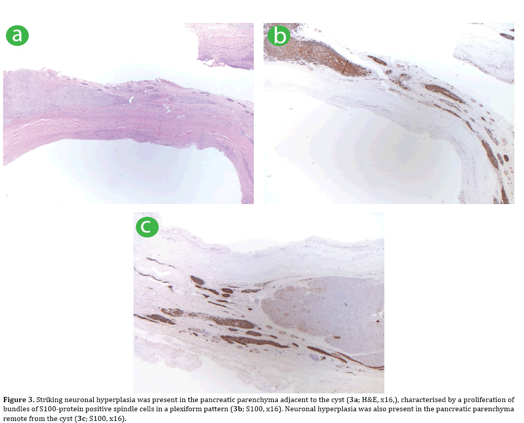 pancreas-hyperplasia