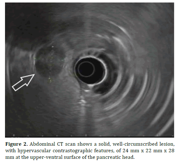 pancreas-hypervascular