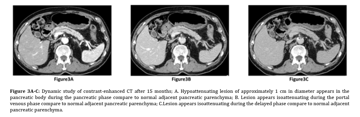 pancreas-hypoattenuating-lesion