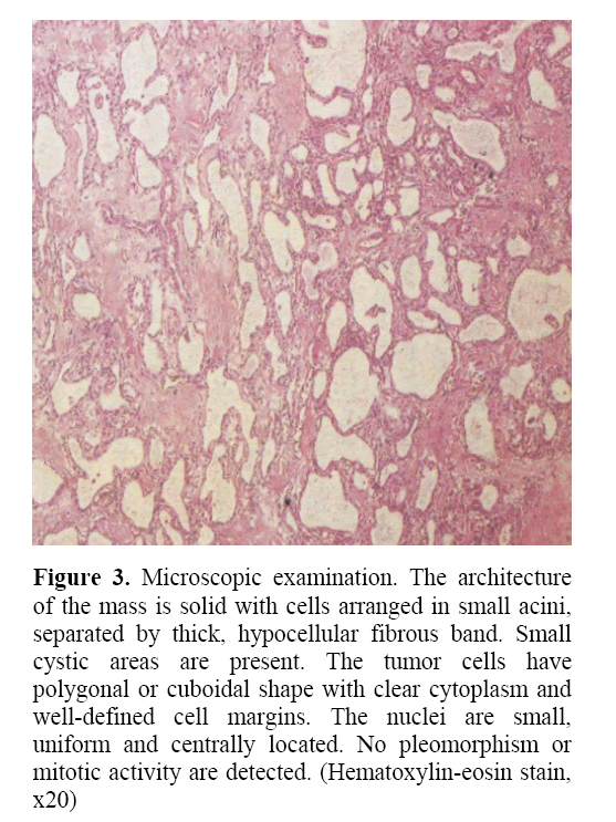 pancreas-hypocellular-fibrous-band