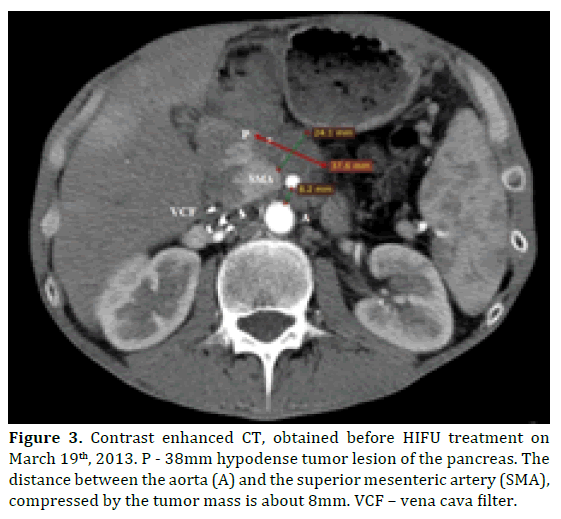 pancreas-hypodense-tumor-lesion