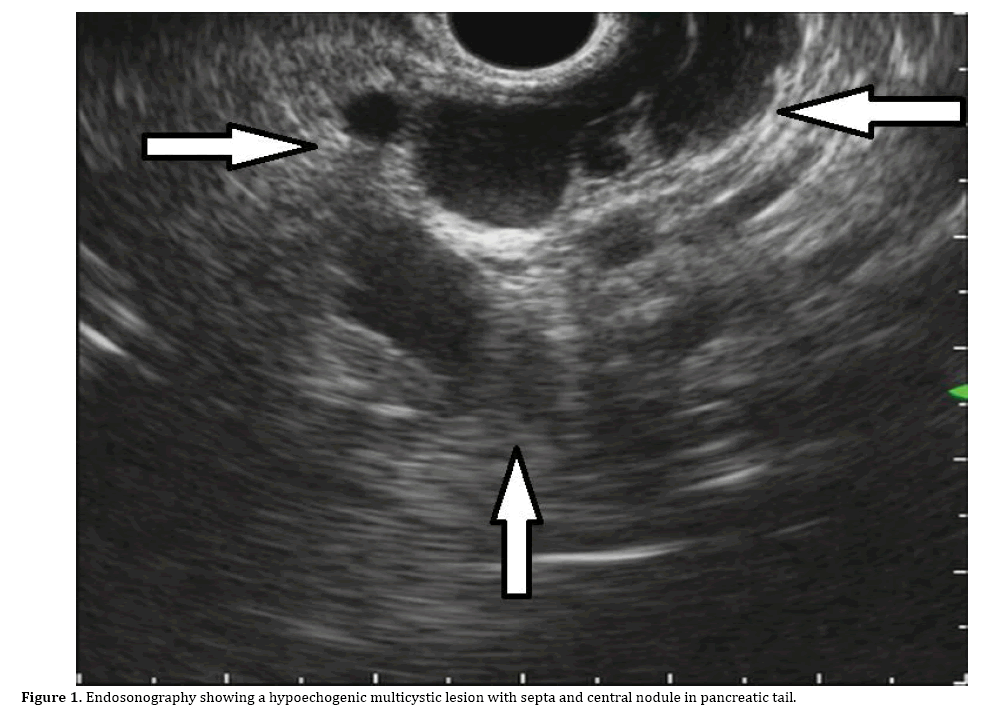 pancreas-hypoechogenic