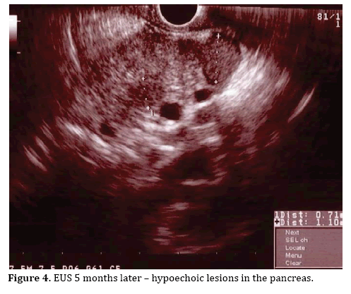 pancreas-hypoechoic-lesions