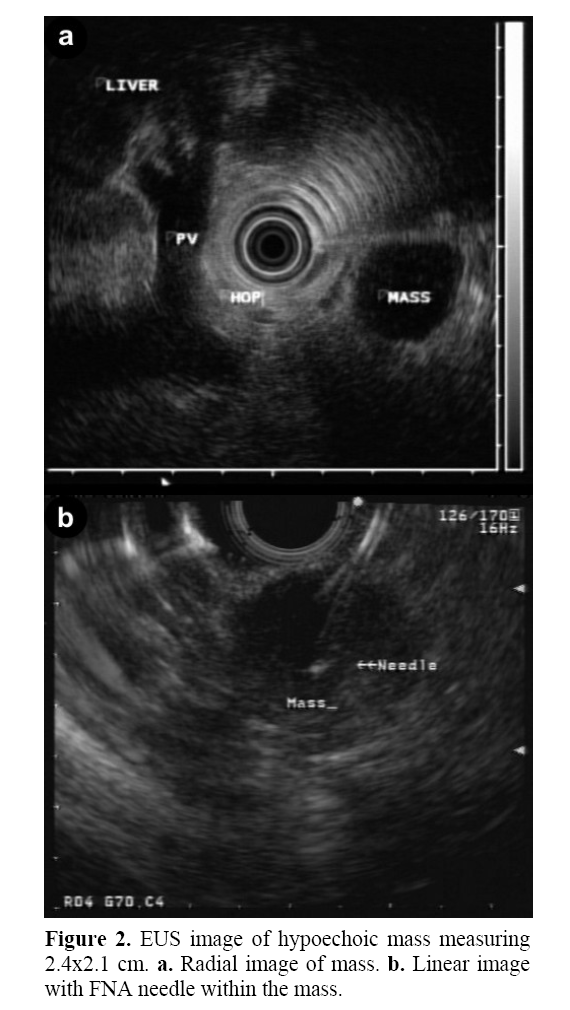 pancreas-hypoechoic-mass-measuring