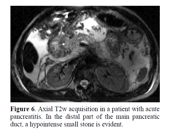 pancreas-hypointense-small-stone