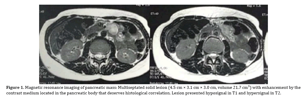 pancreas-hyposignal