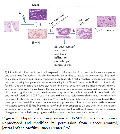 pancreas-hypothetical-progression