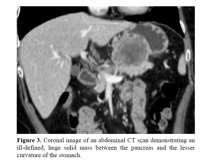 pancreas-ill-defined-huge-solid